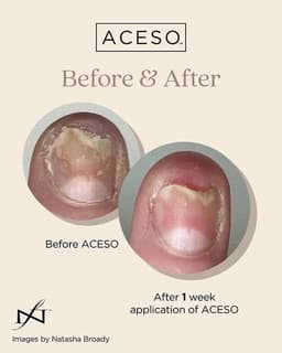 ACESO - Nail recovery program