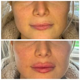 Cheek and lip filler