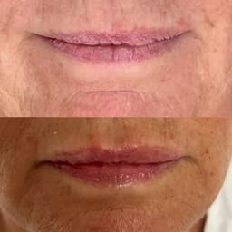 0.5mls lip filler