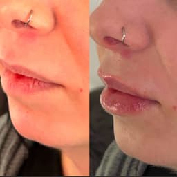 0.7s lip filler