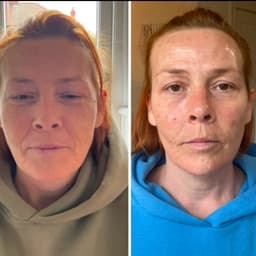 Cheek, chin and jawline filler