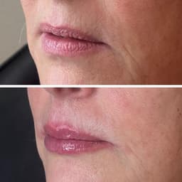 0.8ml lip filler