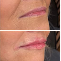 Filler dissolve and refill with 0.8mls