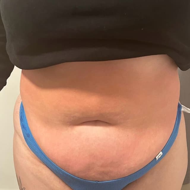 Collagen Lift Belly Treatment
