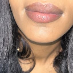 Lip neutralisation (healed)
