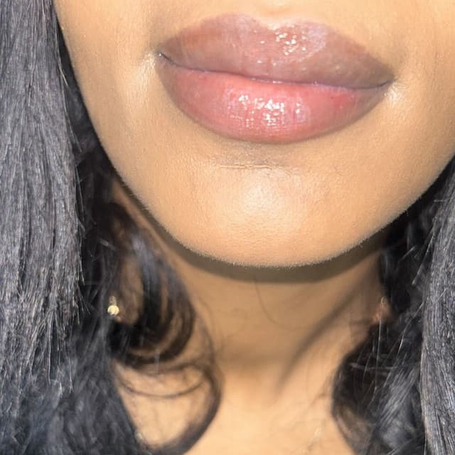 Healed lip neutralisation