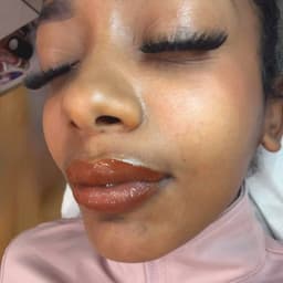 Lip neutralisation (immediately after treatment)