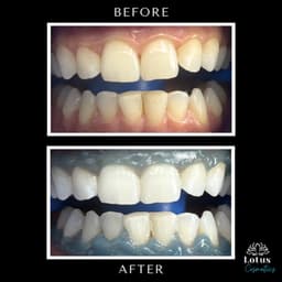 Teeth whitening