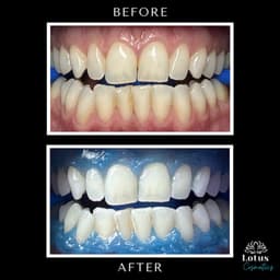 Teeth whitening