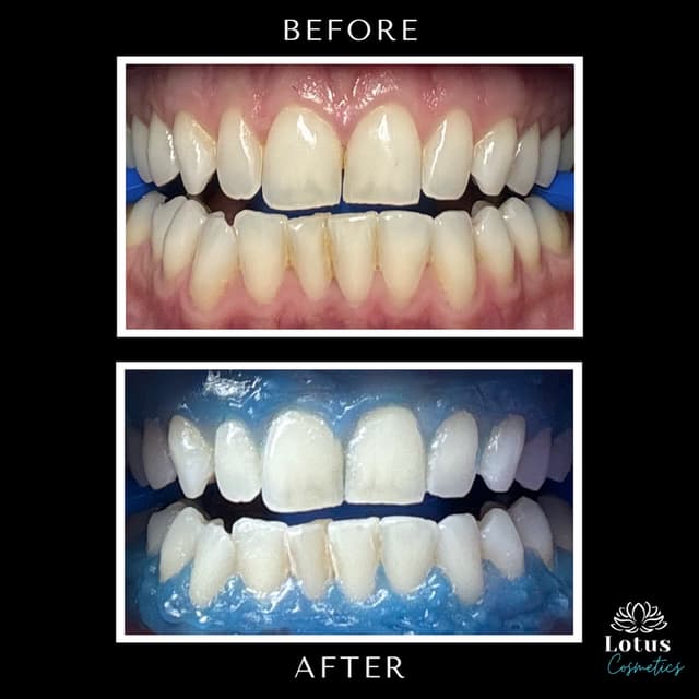 Teeth whitening