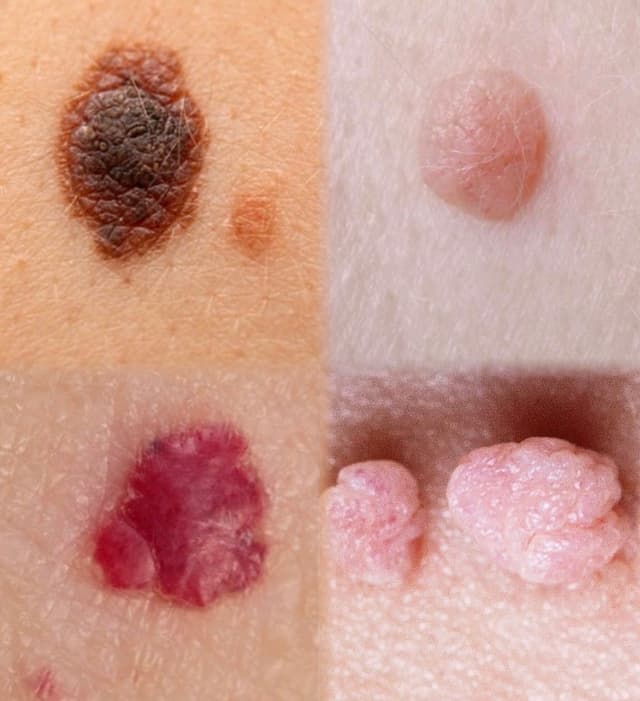 Cryotherapy- Skin Lesion Removal