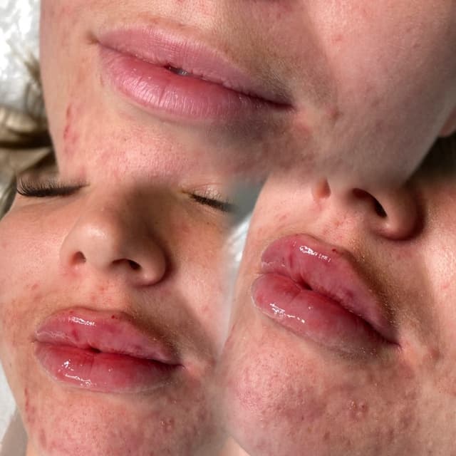 Dermal Fillers - Russian Lips