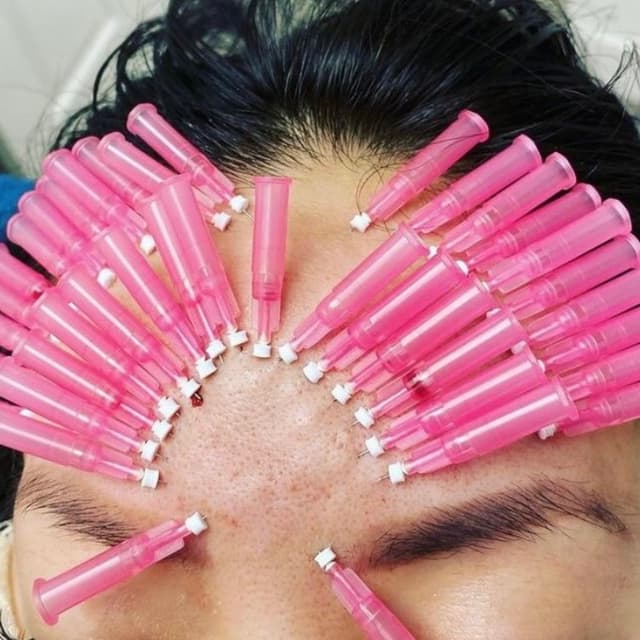 PDO Threads - Forehead Lift