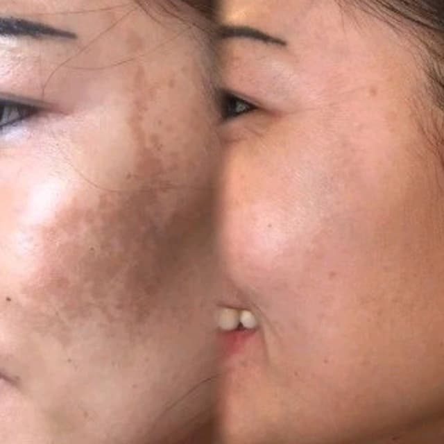 Peppermint Skin Peel