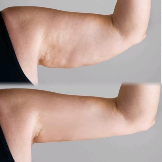 Lemon Bottle - Fat Dissolving