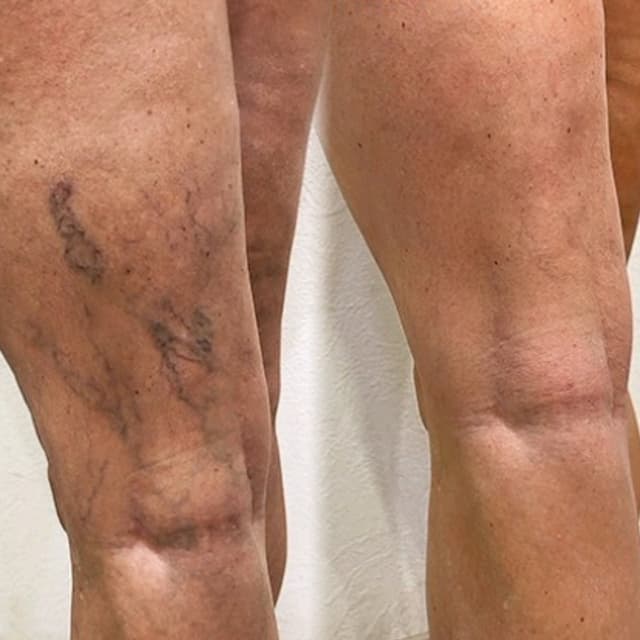 Sclerotherapy - Thread Vein Removal