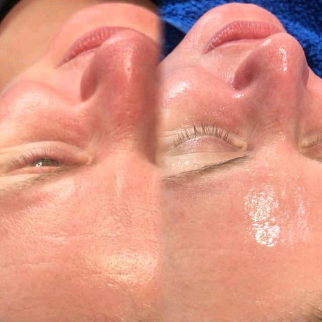 Million Dollar Facial - Miracle Mask