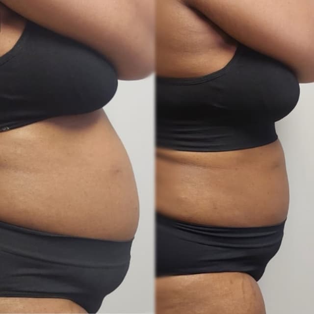 Lemon Bottle - Fat Dissolving