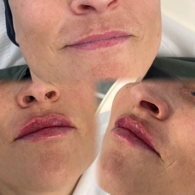 Dermal Fillers - 1ML