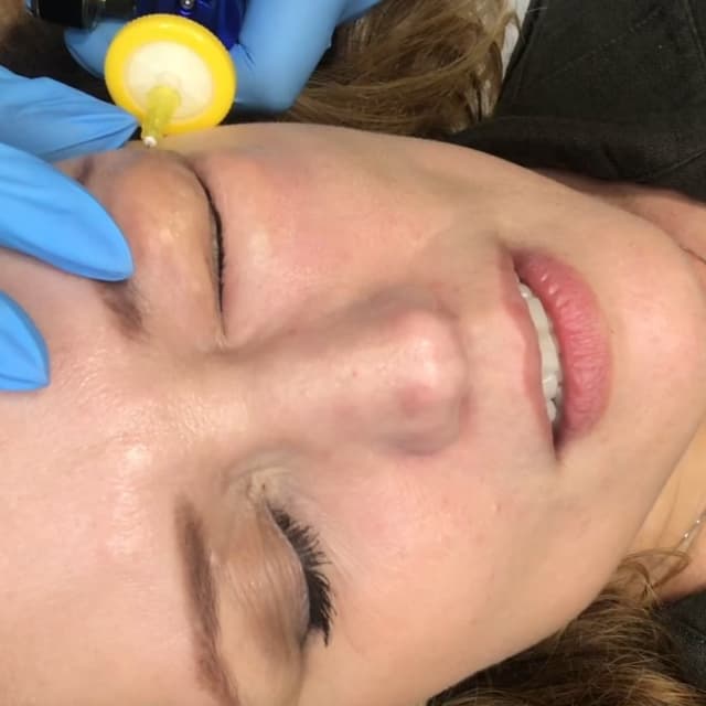 Carboxytherapy - Under Eye Treatment