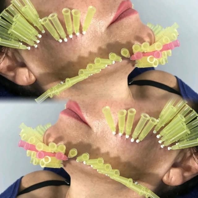 PDO Threads - Jawline, Cheek Lifting & Tightening