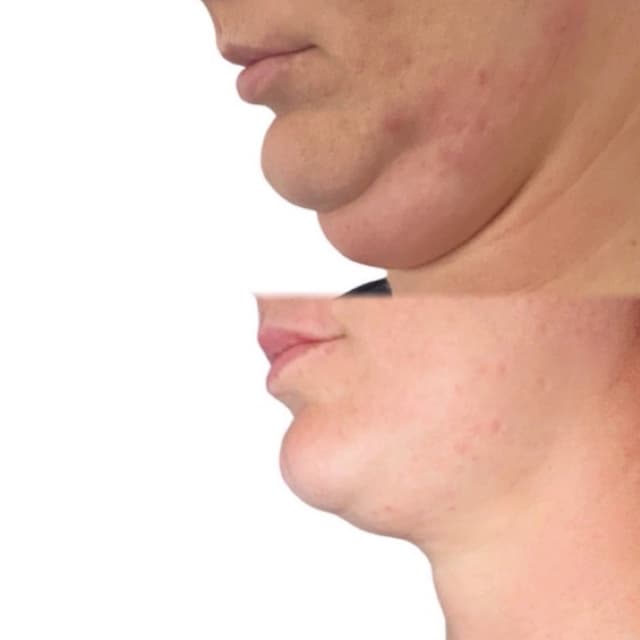 Lemon Bottle - Fat Dissolving