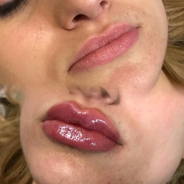 Dermal Fillers - Russian Lips