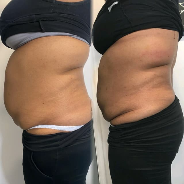 Lemon Bottle - Fat Dissolving