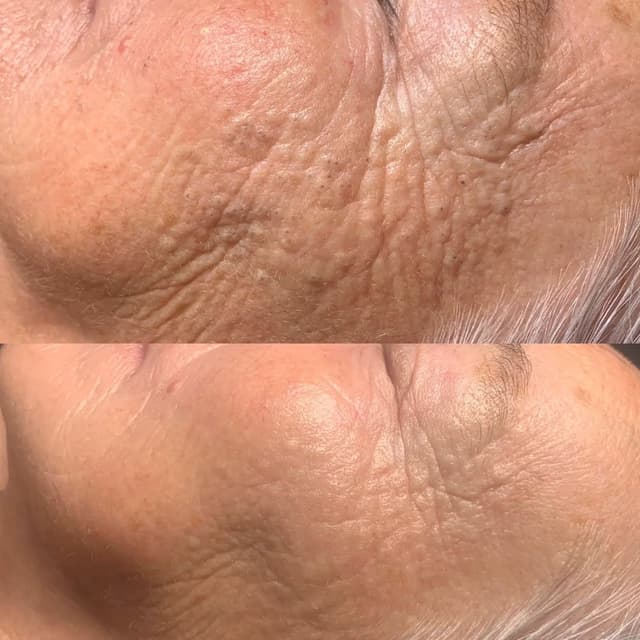 Million Dollar Microneedling Facial
