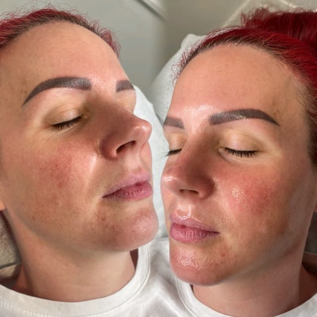 Million Dollar Facial - Miracle Mask