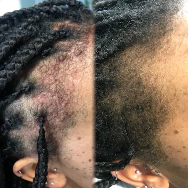 Meso Hair Loss Treatment