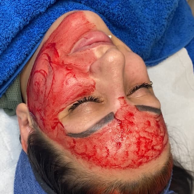 Million Dollar Microneedling Facial