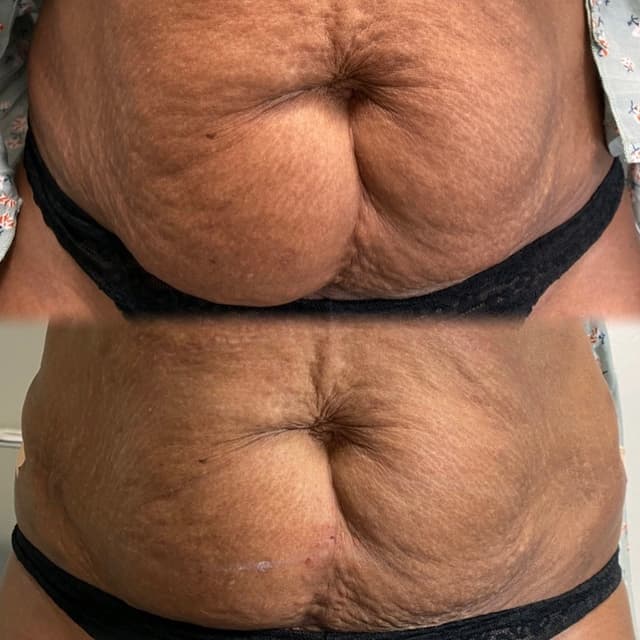 PDO Threads - Stomach Lift & Tightening