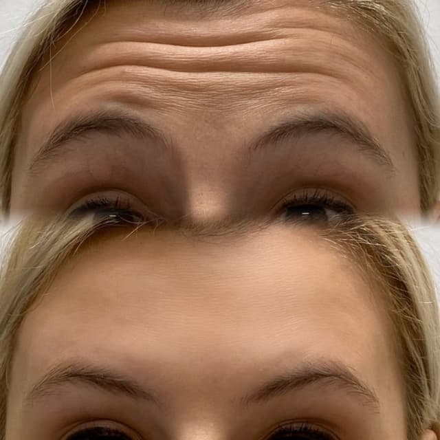 Anti Wrinkle Injections