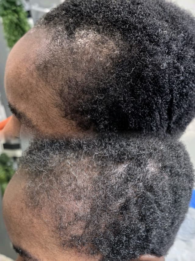 Meso Hair Loss Treatment