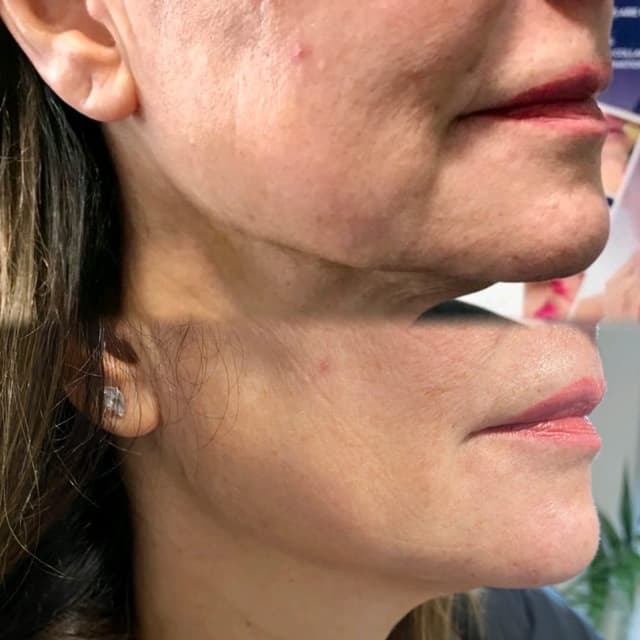 PDO Threads - Jawline Lifting & Tightening