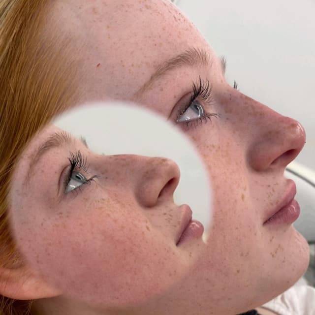 Dermal Fillers - Rhinoplasty