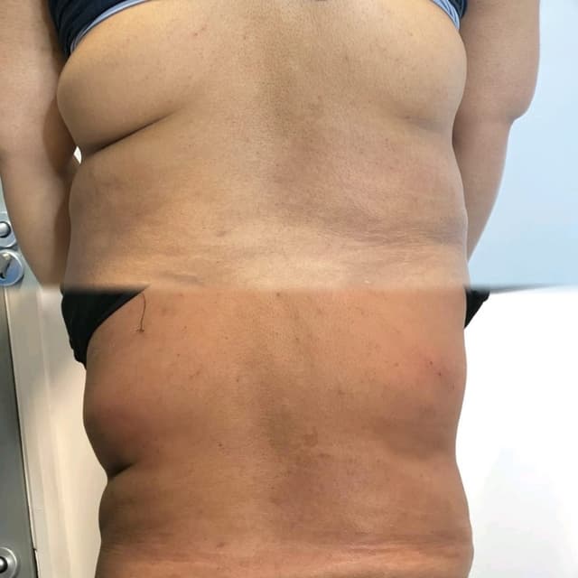 Lemon Bottle - Fat Dissolving