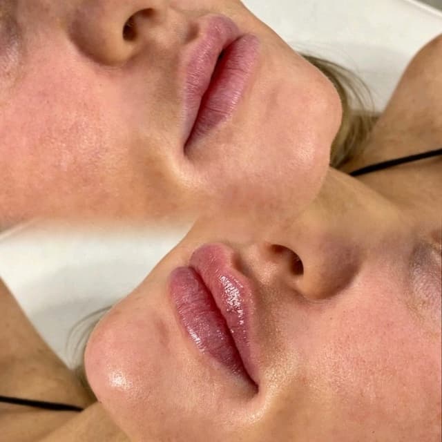 Dermal Fillers - Lip & Chin