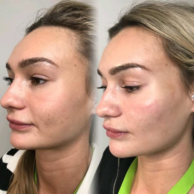 Dermal Fillers - Cheeks