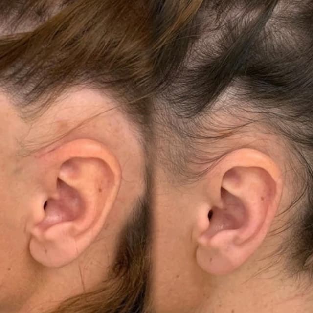 Carboxytherapy - Hair Loss Treatment