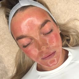 Dermaplaning & Microneedling