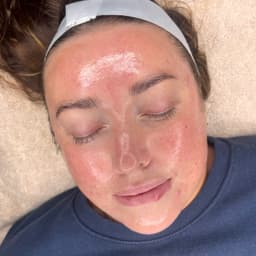 Dermaplaning & BioRePeel