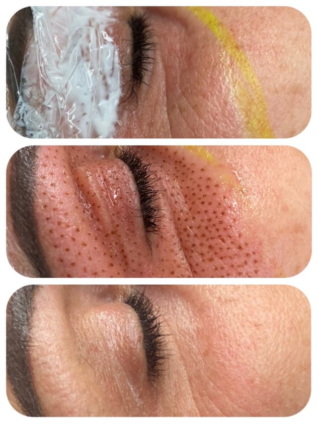 Plasma Pen Treatment