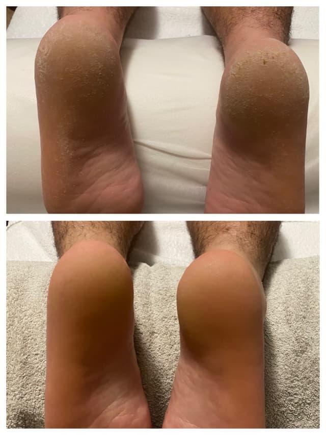 Callus Foot Treatment