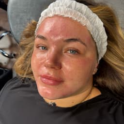 Microneedling with Dermaplane
