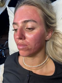 Microneedling with Dermaplane