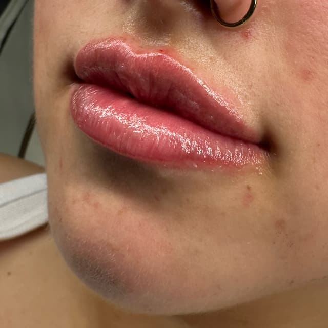 Lip filler