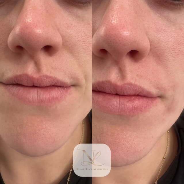 Nasolabial filler