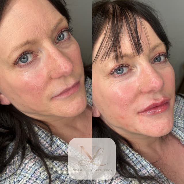 1ml lip filler